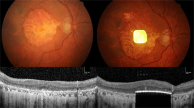Возрастная макулярная дегенерация 